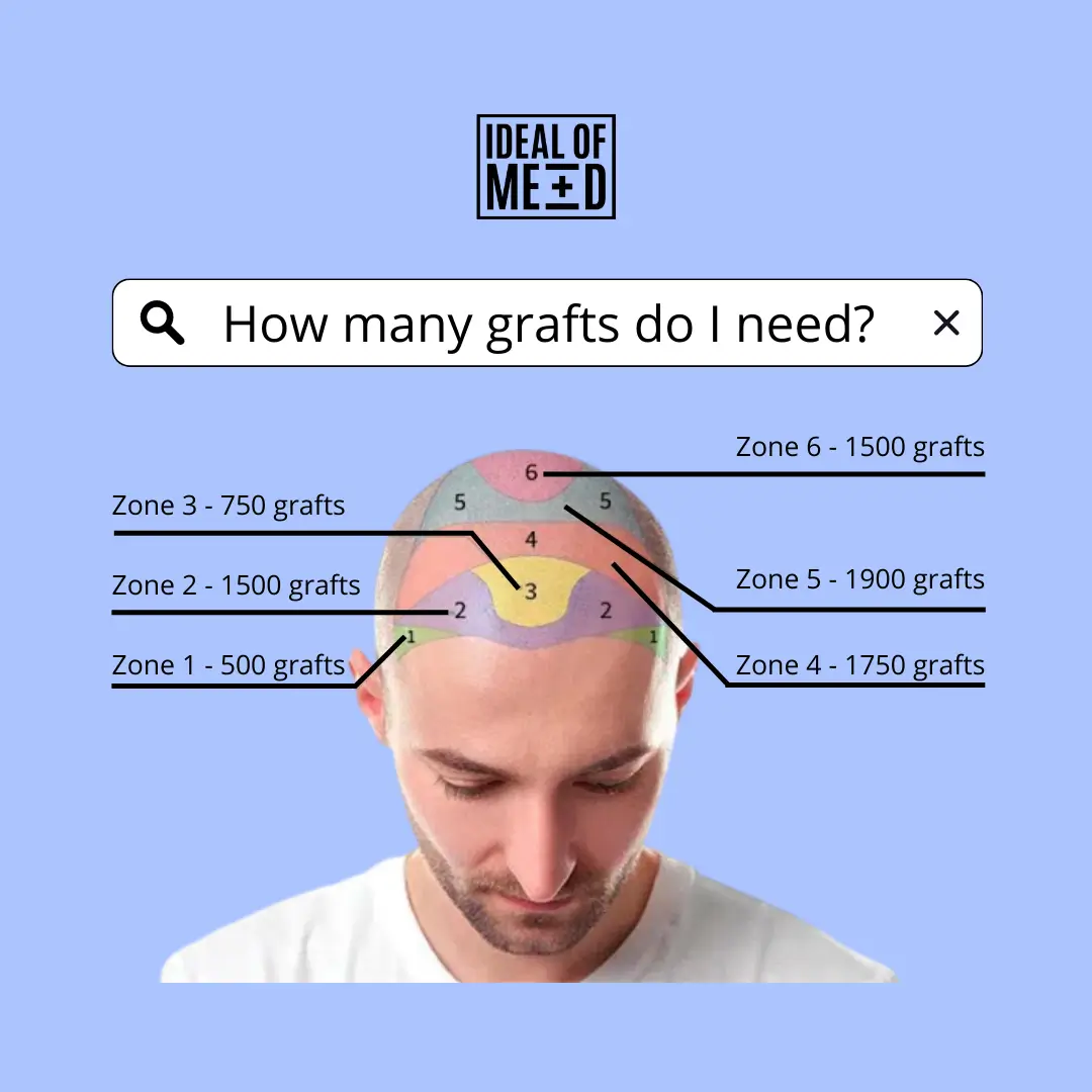 How many grafts do I need - idealofmed hair transplant in Turkey