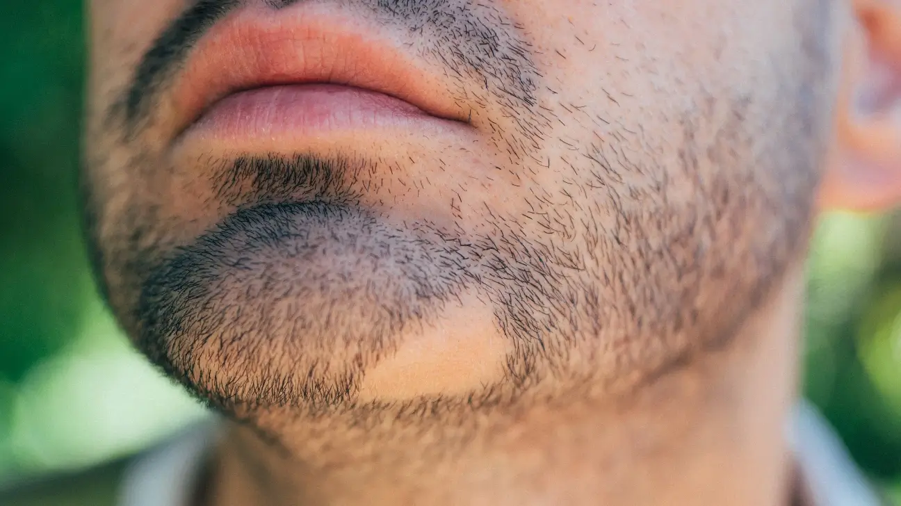 Alopecia Areata of the beard