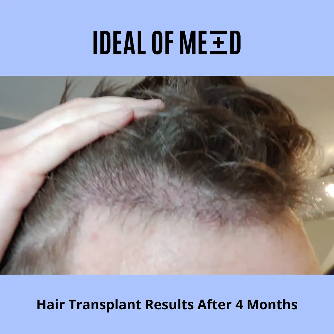 Hair transplant results after 4 months Patient B IdealofMeD