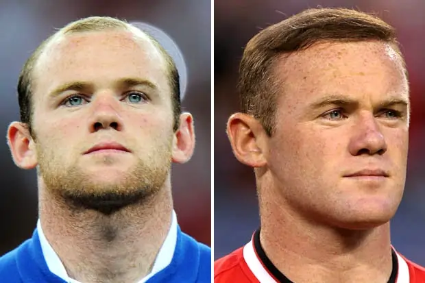 Wayne Rooney Celebrity Hair Transplant Pictures