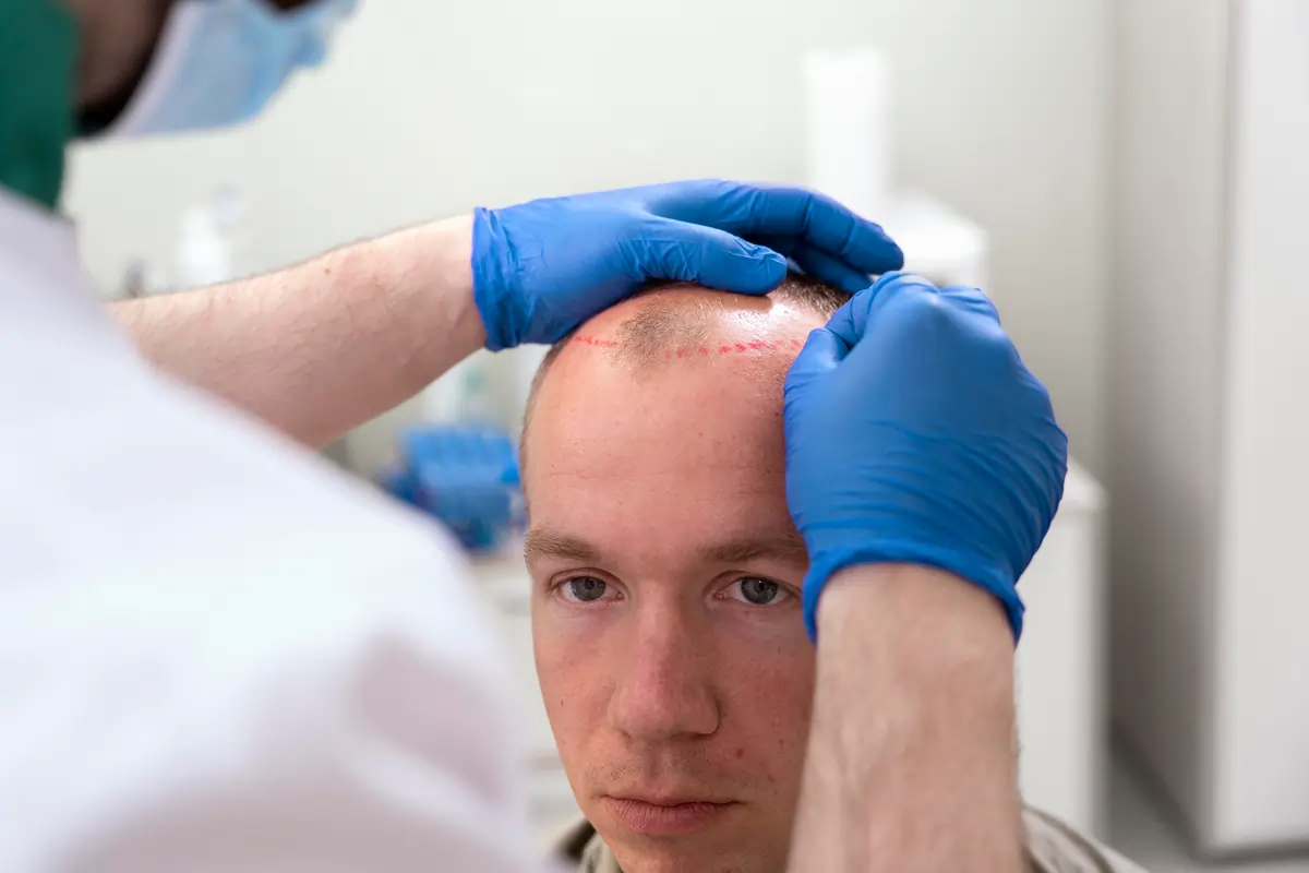 Hair Transplantation Pros and Cons